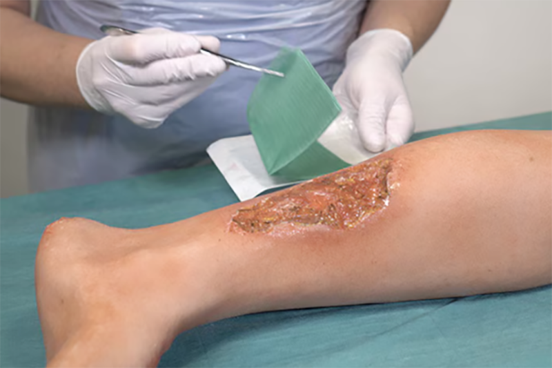 L'infermiere applica una medicazione Cutimed alla gamba L'infermiere applica una medicazione Cutimed alla gamba